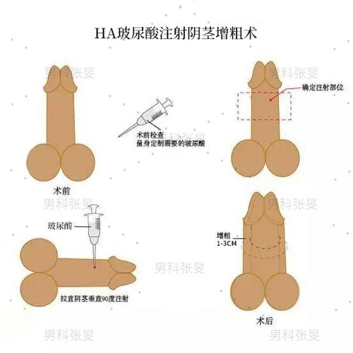 阴茎增粗增大新方法不想手术的可以了解一下