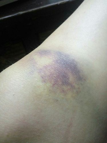 一周前摔了一下,当时膝盖很疼,有个淤青,一直喷云南白药气雾剂,淤青按