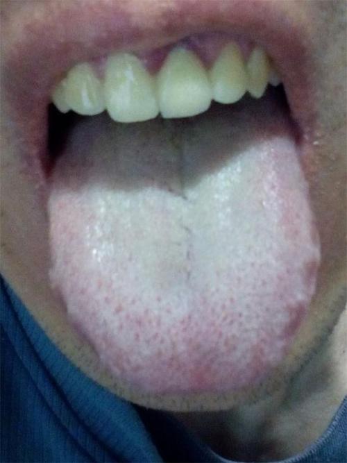 舌苔白,牙齿是黯淡偏黄, 不知道是不是所谓的胃寒湿热