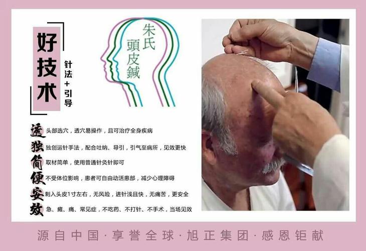 旭正集团【朱氏头皮针】—河北招聘