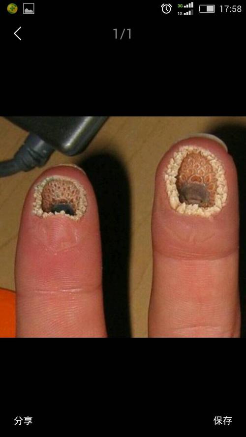 密集恐惧症是什么?