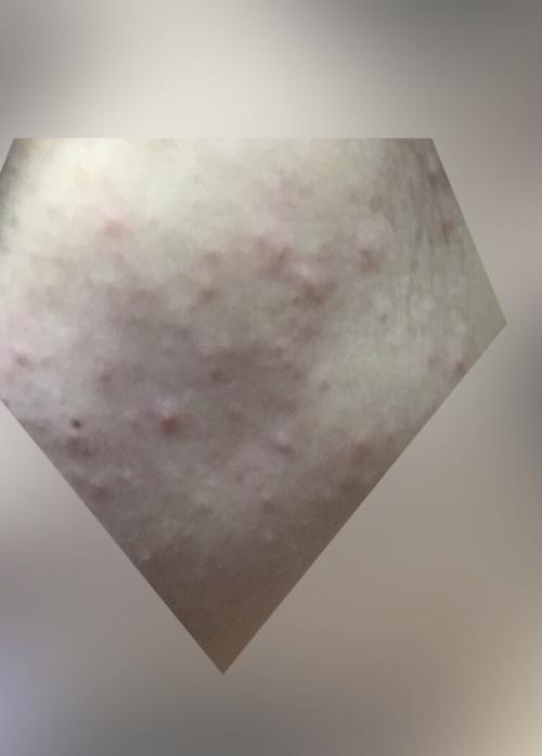 糖皮质激素依赖性皮炎 战痘记