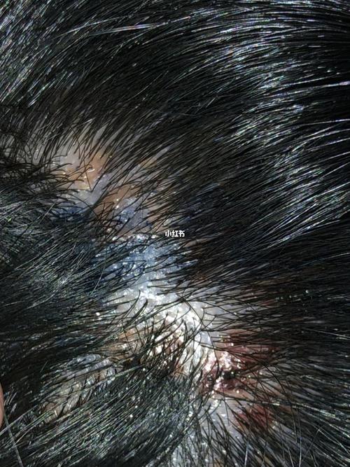 蓝黑头发,头皮灼伤接触性皮炎,维权成功_黑头_维权_皮炎_蓝黑色