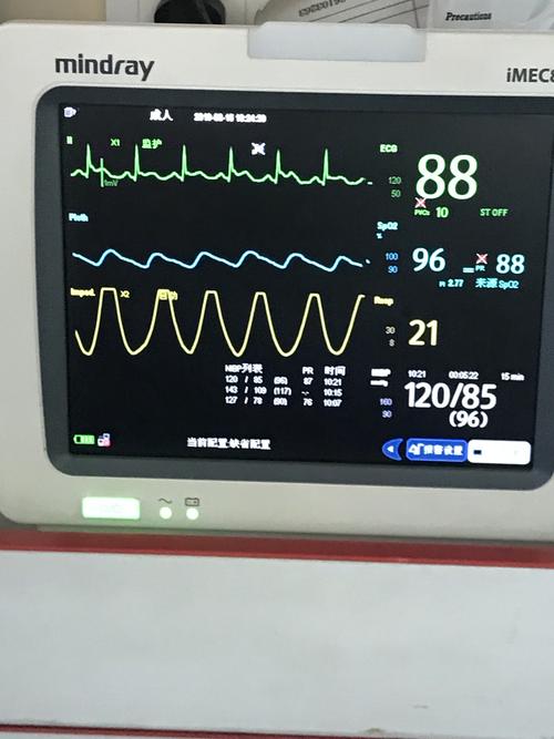 伴四肢抽搐, 心电监护提示患者心率200次/分,标Ⅱ导联波形示室颤波形