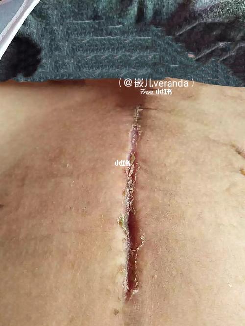 剖腹产全过程纪录~谁说竖切对身体好01_剖腹产_疤痕