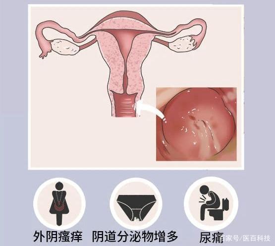 ②滴虫性阴道炎(tv):滴虫性阴道炎是由阴道毛滴虫引起的女性阴道感染