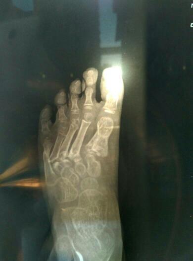 四岁小孩因为车祸导致右脚跖骨1-5粉碎性骨折,目前已经七个月,小拇指
