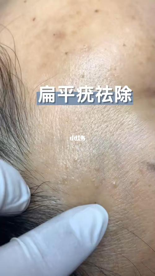 疣类的爆发期 扁平疣,矢状疣皆如此 早祛除早控制病毒