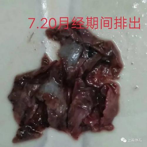 4,遗传菌体,免疫力下降成盆腔炎.