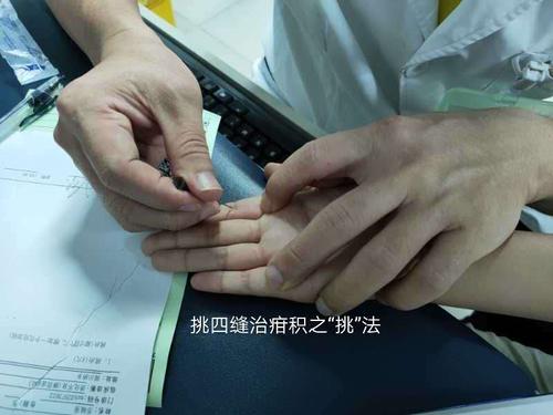 小儿疳积挑四缝穴疗效好