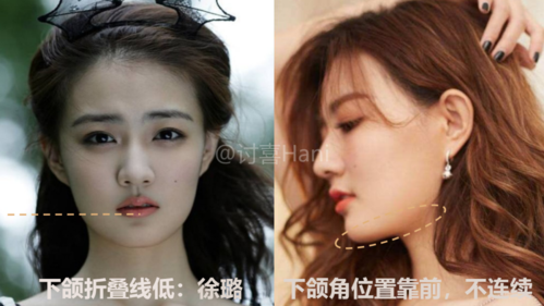 其实徐璐的下颌折叠线有两条,标出的这条是最明显的