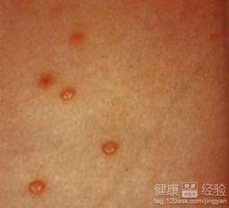硬下疳与软下疳区别