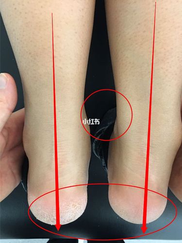 骨盆侧倾,长短腿,右腿足内翻_骨盆_运动健身_健身