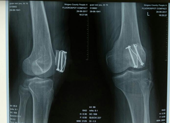髌骨骨折微创空心钉张力带内固定