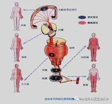 运动障碍:单侧锥体束受压,引起病变以下同侧肢体痉挛性瘫痪;双侧锥体
