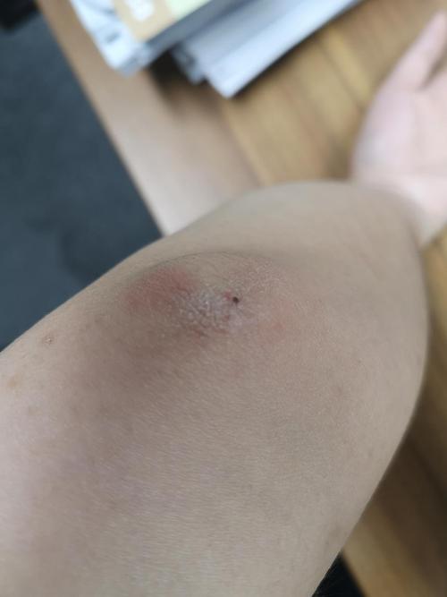 胳膊肘起皮咋治!