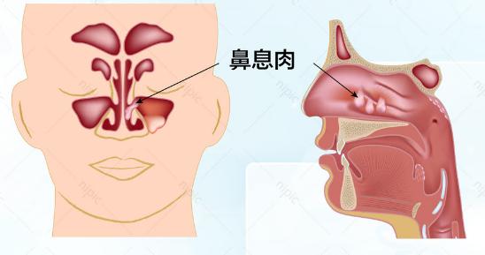 鼻息肉的危害居然这么大!