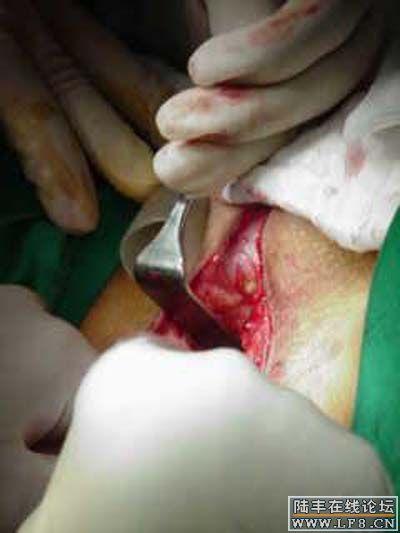 男变女手术全过程(恶心!