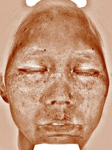 最近发现脸上有黑黑的东西,一开始以为是晒斑,后面才知道是黄褐斑