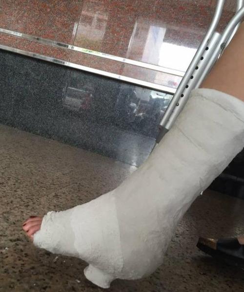 我们的小腿骨折,但是我们的足部也会感到肿胀而胀痛,为什么呢?