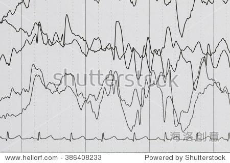 abnormal eeg brain wave on electroencephalogram eeg wave back
