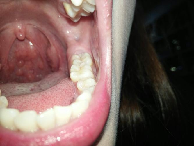 喉咙里起了好多小东西,只有早上醒那了觉得有点痛,总是感觉喉咙有痰