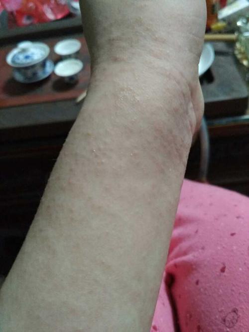 过敏性湿疹皮炎图片