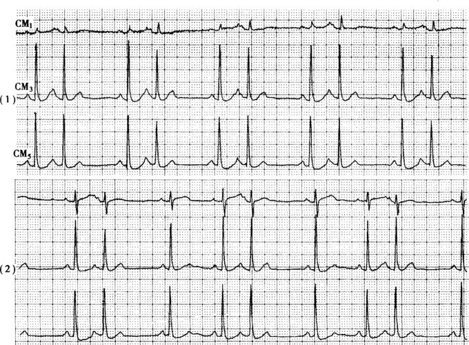 【心电图诊断】 ①窦性心律; ②房性早搏二,三联律; ③慢性冠状饿脉