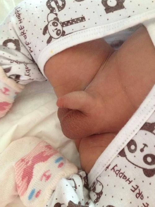 未满月宝宝昨晚用了尿不湿 今天小鸡鸡有点红肿怎么办