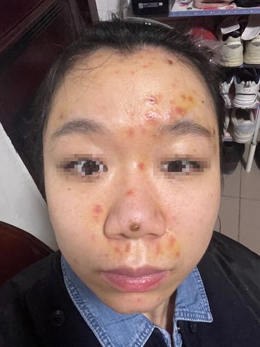 成年人得水痘全过程