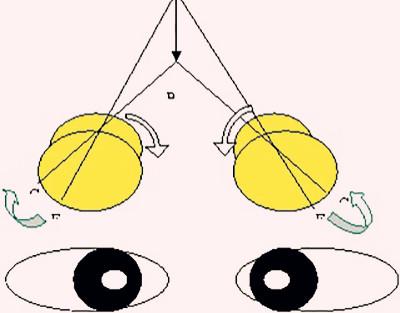 看东西老有重影是怎么了?可能是这个病导致的!