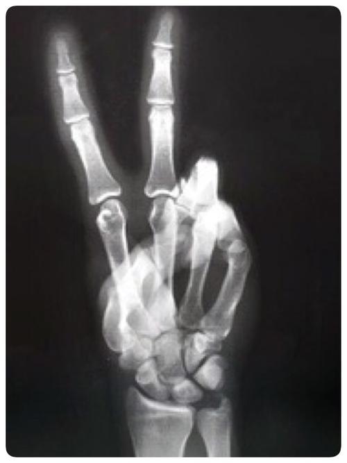 求v字手的x光片或这张图原图