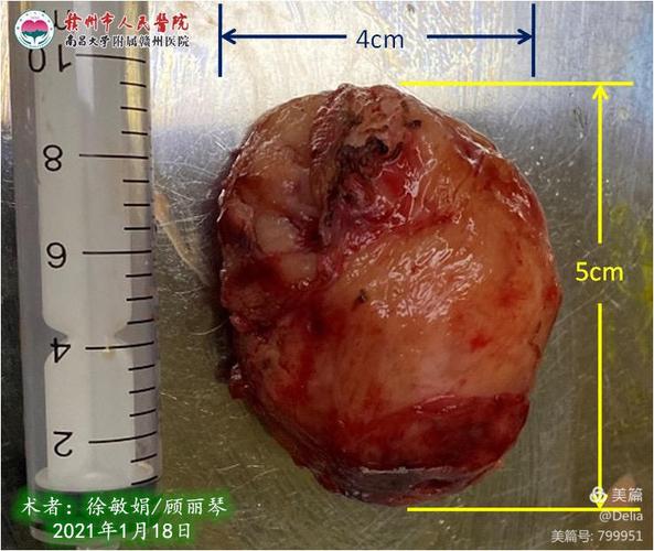 镜辅助下子宫肌瘤剔除术1例——省内首例分享暨2021年1月18日手术日记