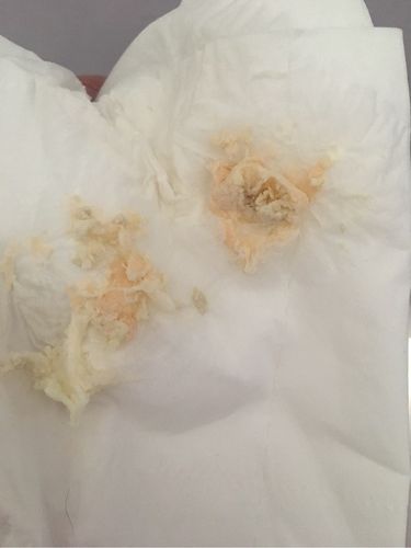 我是移植第七天,刚才打喷嚏,下身掉出一团这个东西,这是胚胎掉出来了