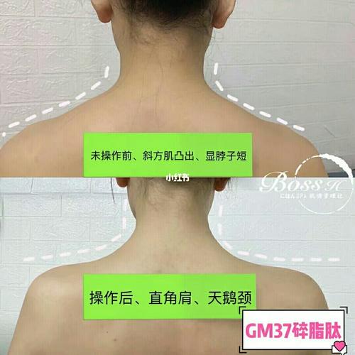 天鹅颈, 脂肪堆积,肩颈淤堵 导致斜方肌突出,肩颈劳累