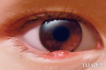 下眼睑红肿的原因介绍 两大方法教你还原健康双眼