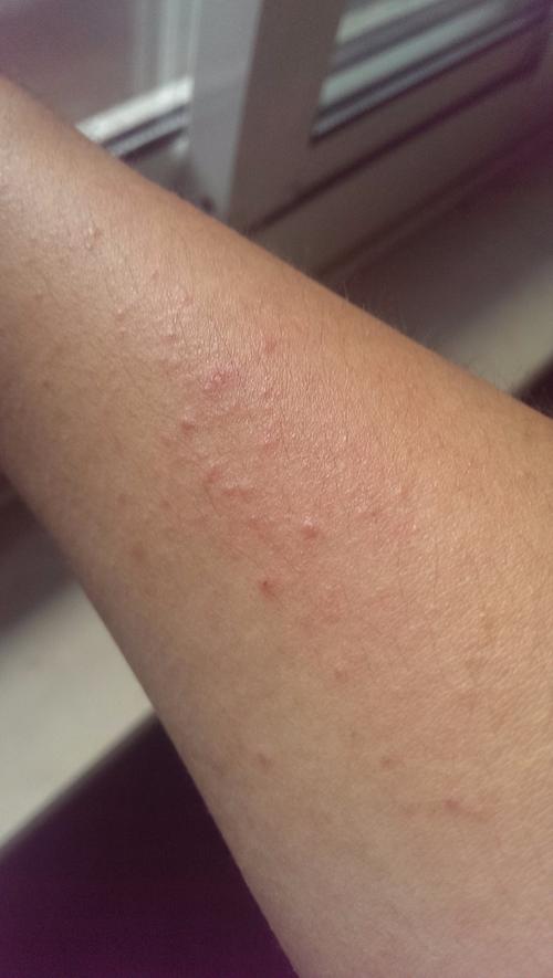 最近天气比较湿热,上臂上长了一些小疙瘩,比较痒,有点像皮炎,用皮炎平