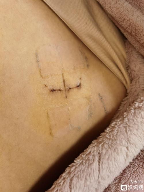 吃什么一点胃口都没有,甚至还有点拉肚子,头扯着痛,真的比伤口的痛还