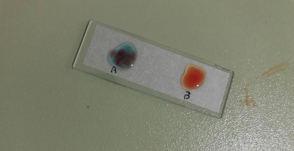 记长铁一中第一节高一生物选修课——abo血型鉴定