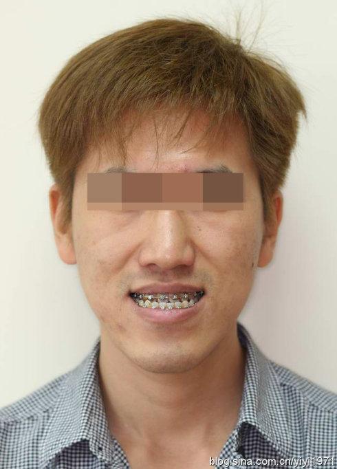 与香港大学菲腊牙科医院正颌外科联合治疗的骨性地包天患者(图片刚刚