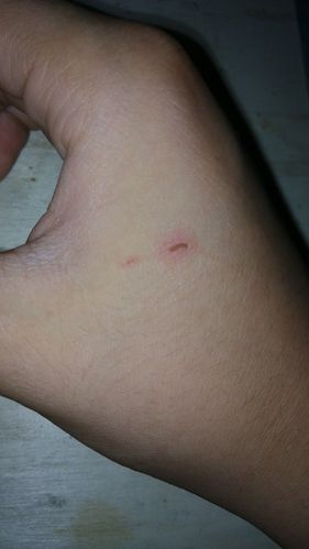 请问健康狗的爪子上含狂犬病毒吗,我被自家的狗狗爪子抓伤,伤口米粒