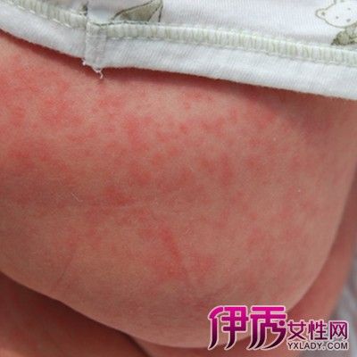 【图】新生儿红斑图片欣赏 其6大护理要点介绍