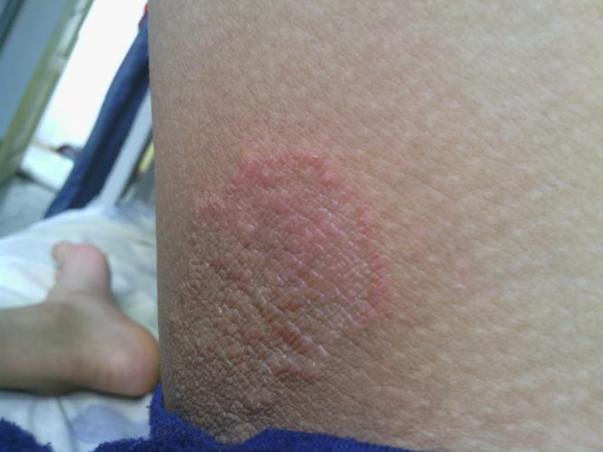 大腿内侧靠近阴部的地方,长了一片红疙瘩,像是土话说的泛子,有时候会