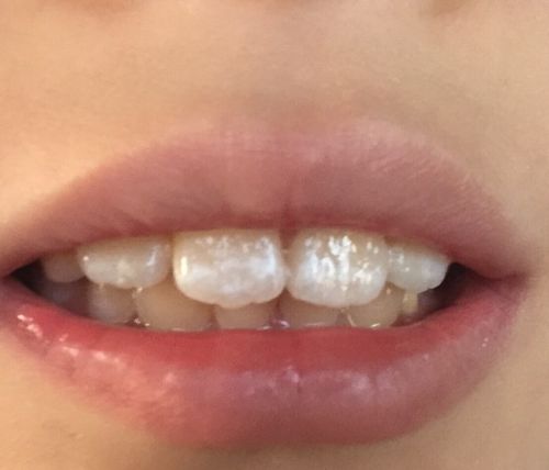 8岁孩子刚换牙两年,牙齿上就有白色的花点牙斑,去当地