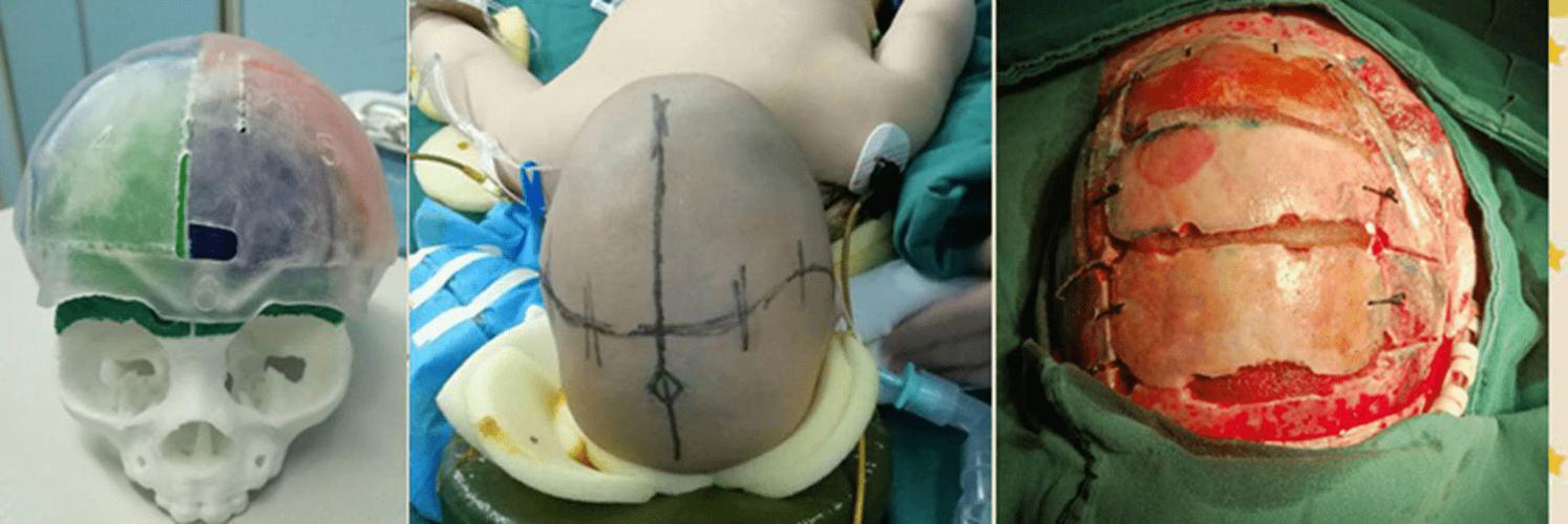 如何做到颅缝早闭早诊早治呢