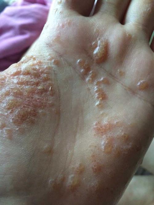 好几年没发作的现在湿疹又