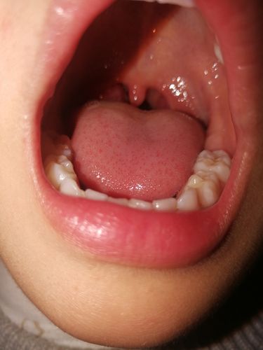 宝宝四岁了扁桃体一侧肥大总说不舒服,妈妈们有没有什么好妙招