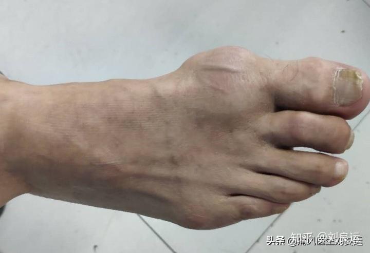 尿酸降低了痛风石就溶解了?