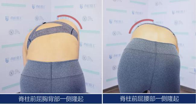 你以为的脊柱侧弯可能是假的