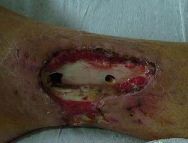 骨髓炎临床症状是什么样的